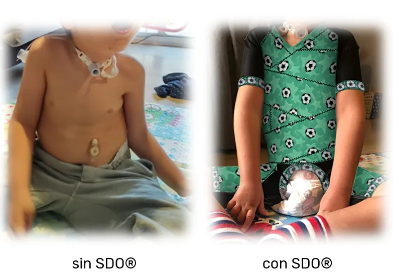 Comparison of a child's trunk without the dynamic orthosis and wearing it